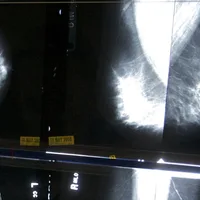 When should you get a mammogram? Conflicting advice makes it hard to know